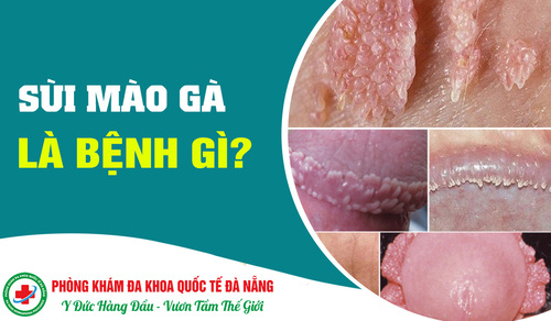 Dấu hiệu nhận biết giai đoạn đầu bệnh sùi mào gà diễn ra như thế nào?