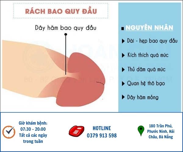 Rách bao quy đầu ở nam giới